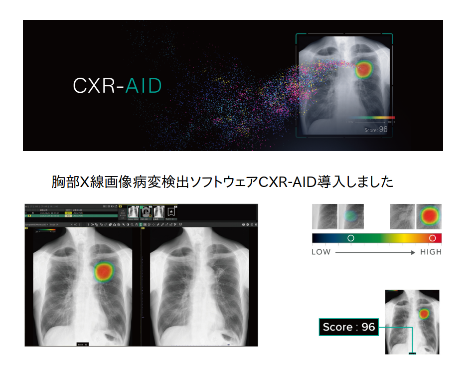 胸部X線画像病変検出ソフトウェア CXR-AID
